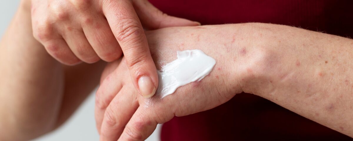 Gợi ý 7 sản phẩm kem làm dịu da kích ứng, mẩn đỏ
